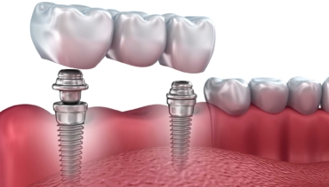 Dental Implants